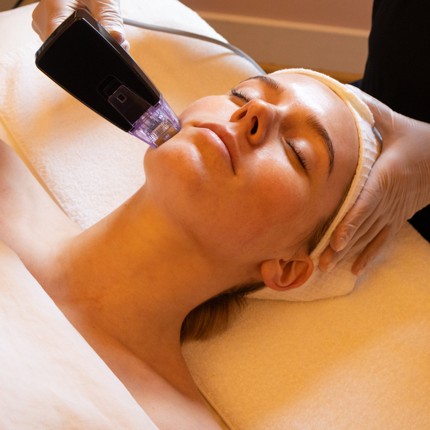 RF Microneedling at Resonance Marin, Corte Madera