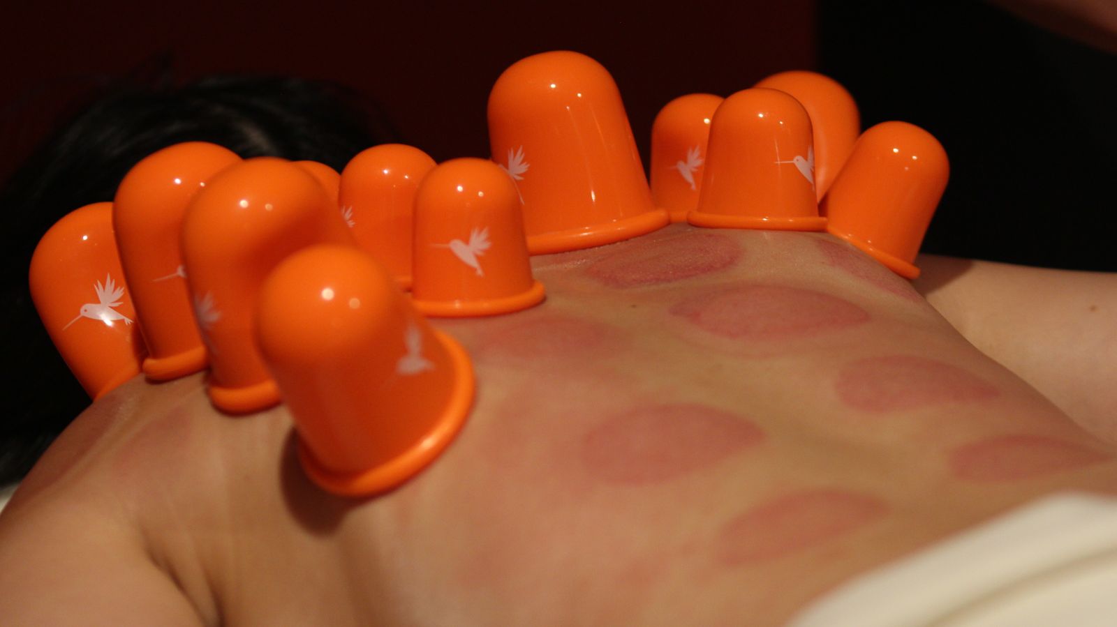 Cupping Therapy at Resonance Marin, Corte Madera, treatment detail